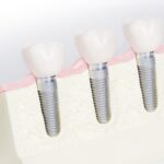 implantes dentales peru treatdent